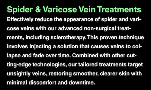 Non Surgical Spider Varicose Vein Treatment Sclerotherapy Mississauga Oakville